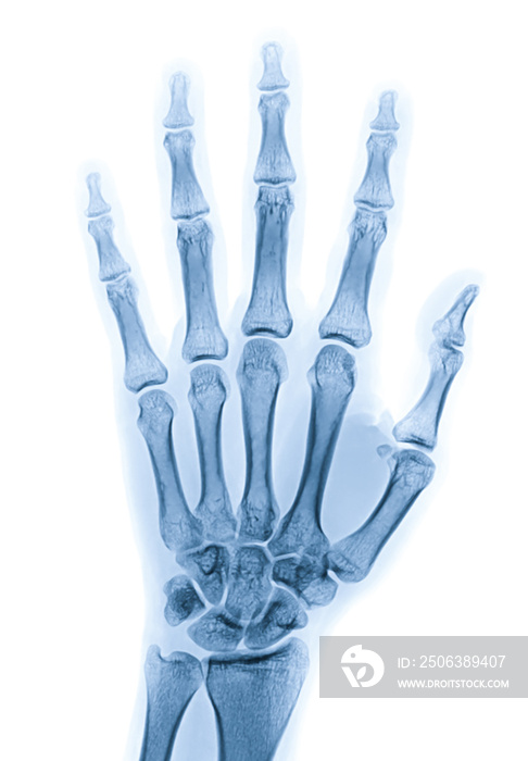 X-ray image of left hand isolated on white background