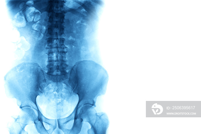 High quality X-ray image of Lumbar spine with copy space. Medical and health concepts.