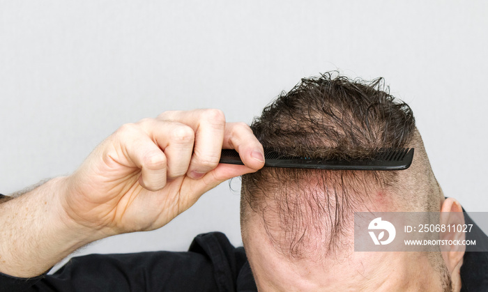 头发稀疏的男子使用梳子导致大量脱发