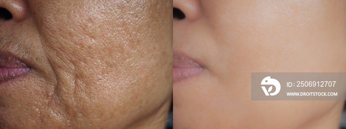 Image before and after treatment rejuvenation surgery on face asian woman concept.Closeup wrinkles d