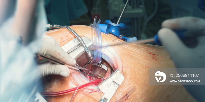 retractor and surgeon hands for open heart cardiac surgery in hospital cardiovascular microsurgery w