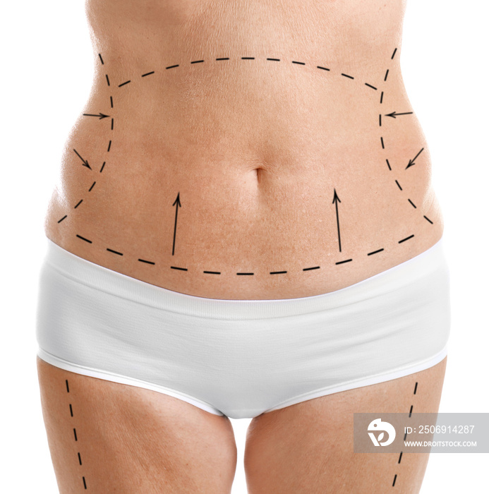 Mature female body with marks for plastic operation, white background. Liposuction concept