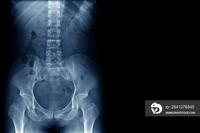 人体正常脊柱、撕裂、骨盆、双髋关节和右侧空白区域的x射线图像