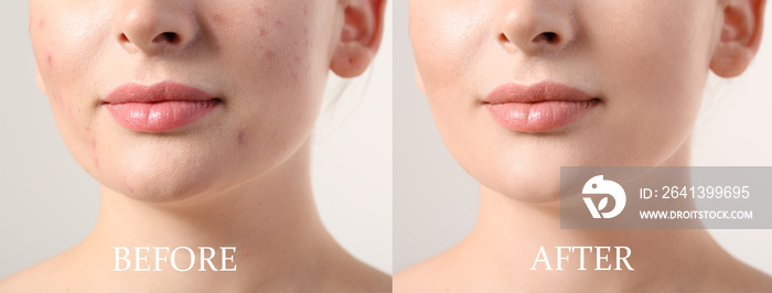 Young woman before and after acne treatment on light background, closeup