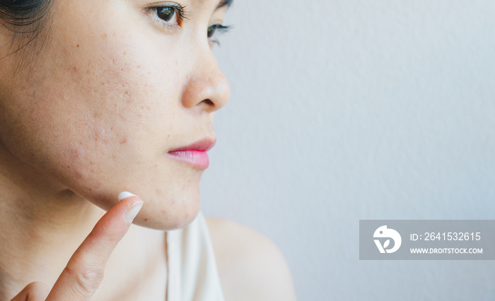 亚洲女性在脸上涂痤疮膏。