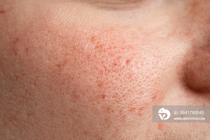 A closeup view on the cheek of a caucasian girl suffering with problematic skin, open pores and visi