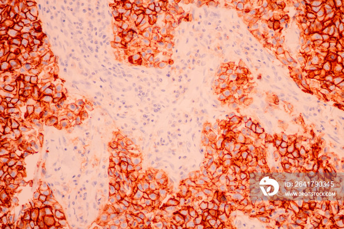 View in microscopic of pathology cross section tissue ductal cell carcinoma or adenocarcinoma diagno