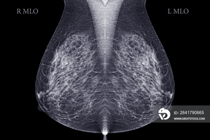 X射线数字乳房X光片或乳房X光图像MLO视图，用于筛查癌症。