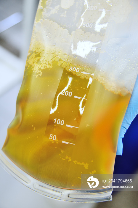 plasma in a plastic bag in the hands of a nurse