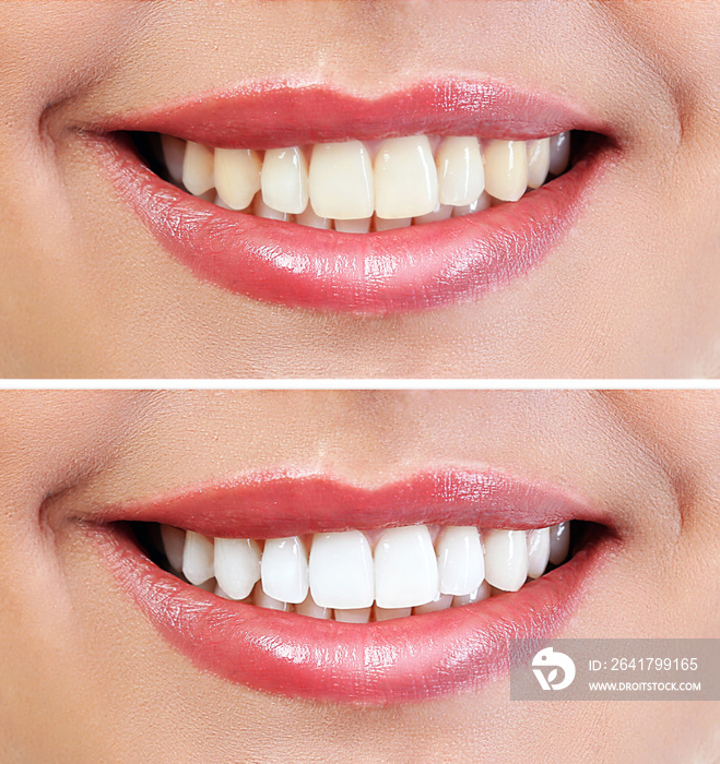 Demonstration of dental whitening result, before and after procedure. Dentistry concept.