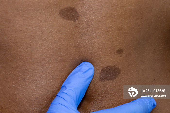 Medical dermatologist examines benign moles in African patient.