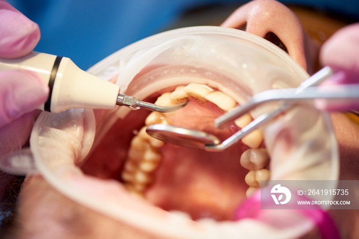 在一家采用创新技术的诊所对一名牙垢患者进行检查的宏观照片。
