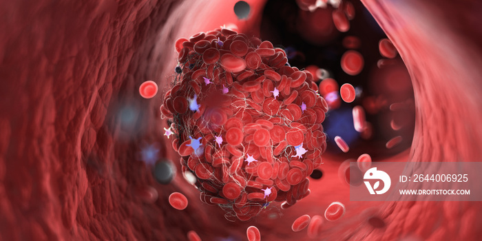 3d rendered medically accurate illustration of a blood clot