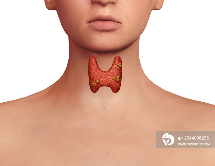 Thyroid cancer. development of cancer in the thyroid gland in the human body. 3D rendering