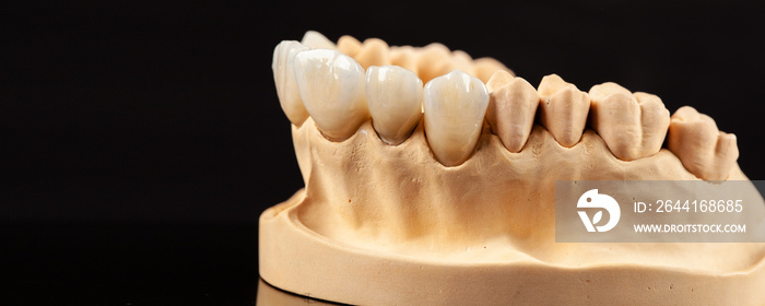 Close-up view of dental layout of upper veneers of teeth prothesis