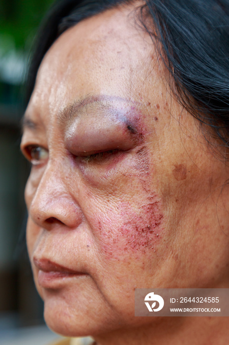 Elderly injury to the eyelid