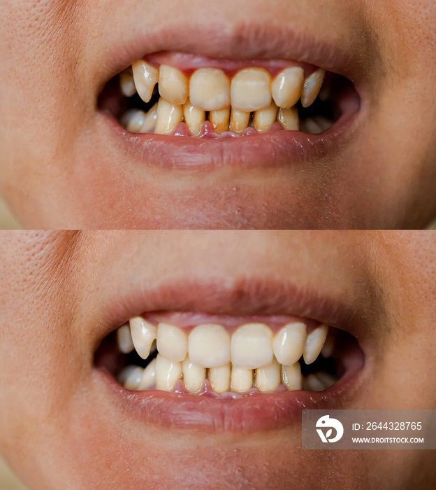 Natural Woman’s Teeth Before And After Whitening