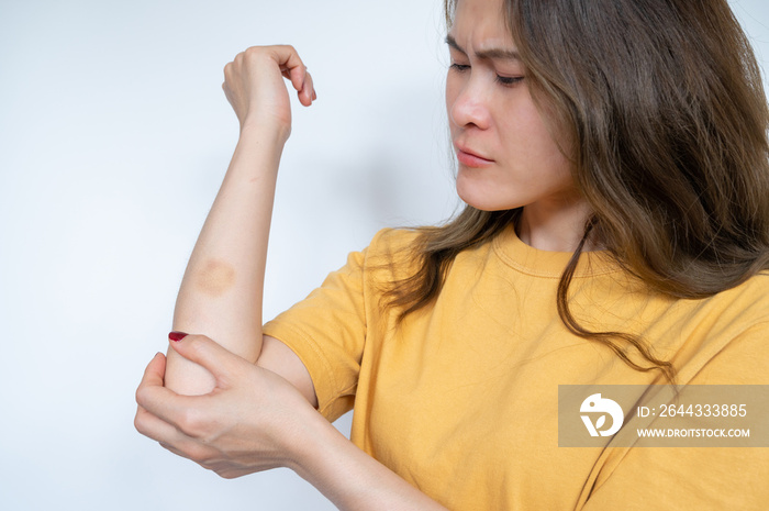 Worried woman having bruise occur on her skin. A bruise is a common skin injury that results in a discoloration of the skin.