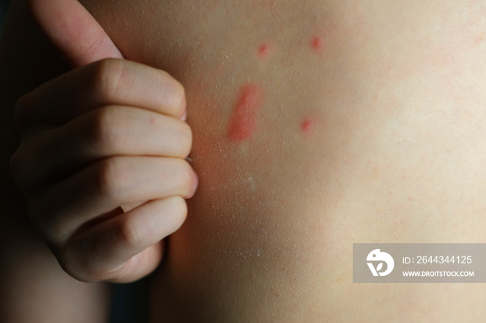 naked back of boy, child 8 years old red papules on skin, blisters from mosquito bites, skin irritations, allergic rashes, concept of children’s health, body care, pediatrics