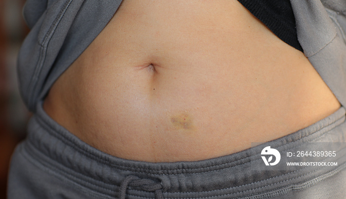 Adult woman with green yellow bruise, hematoma on her stomach at home. Injecting medical therapy, chemotherapy, diabetes. Medical concept. Health and medical concept