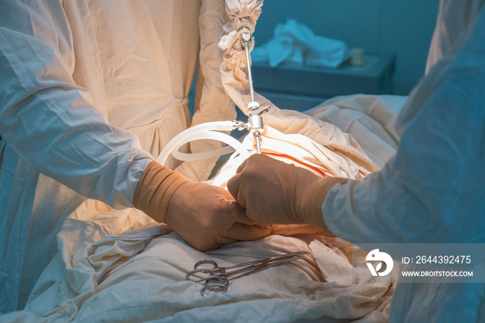 close-up hands of pediatric surgeons perform surgery using laparoscopic ports for endoscopic surgery. In a sterile operating room. Pediatric surgery, treatment of inguinal hernia in children by PIRS