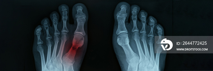 X ray of feet with tarsal fracture closeup