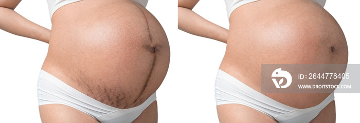 Pregnant Asian woman have Stretch marks on belly and clean belly, Isolated on white background, With clipping path, Before and after.