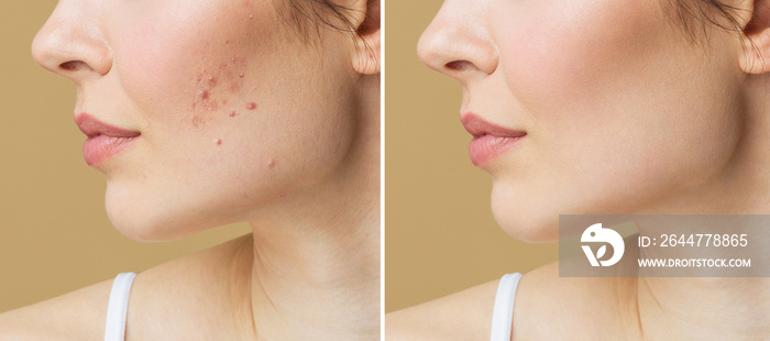 Young woman before and after acne treatment. Skin care concept.