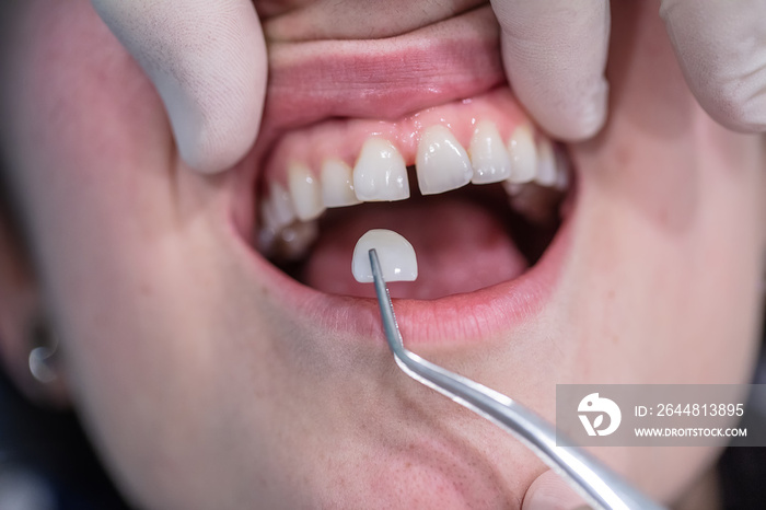 陶瓷假牙替代缺失的天然牙齿。