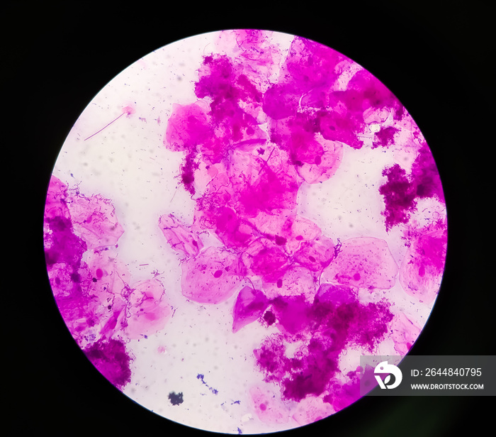 Microscopic close view of high vaginal swab Gram stain smear, 40x. diagnosis of Bacterial vaginosis 