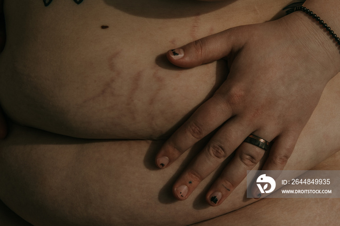 closeup hand on stomach with stretchmarks in sunlight