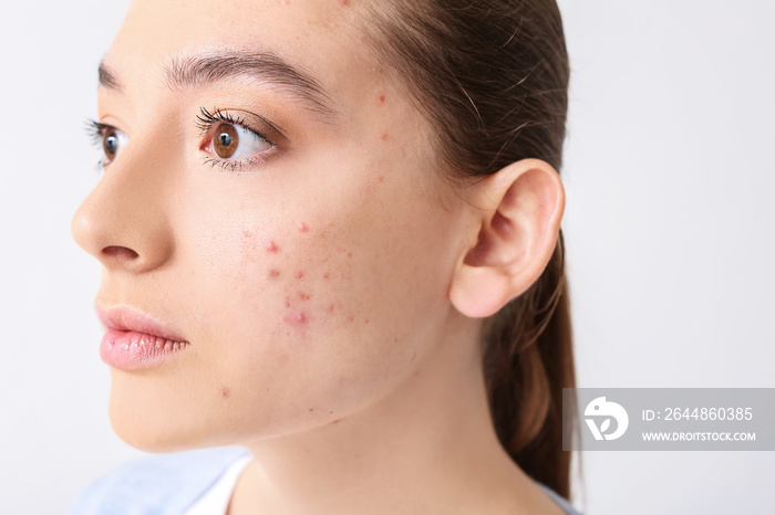 Young woman with acne problem on light background
