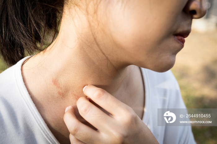 Closeup woman hand scratching skin itchy because of allergy,allergic rash dermatitis eczema skin or fungal,female people have itching from sweat allergies,atopic dermatitis with red rash on the neck