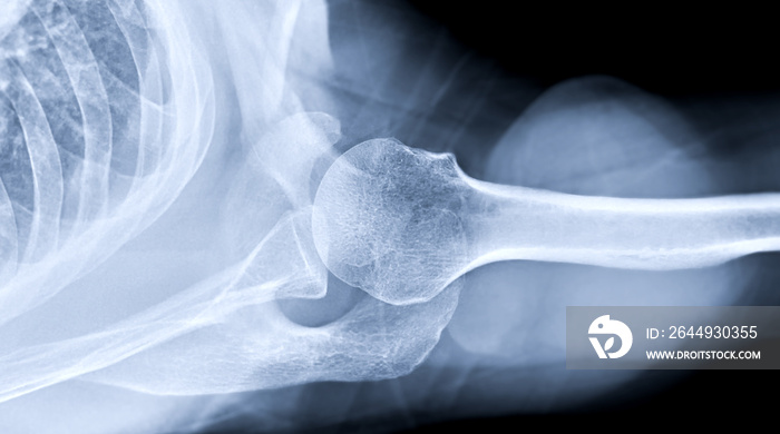 X-ray Shoulder joint shoulder transaxillary view for diagnosis fracture of shoulder joint.