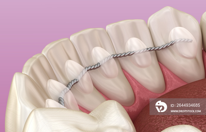 Retainers dental installed after braces treatment, Medically accurate dental 3D illustration