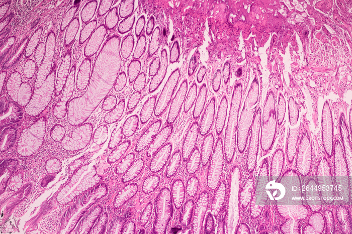 View in microscopic of ductal cell carcinoma, adenonocarcinoma from human breast cancer, tissue section by H and E stain.Pathology diagnosis.Medical concept. Under microscope, magnification 400X