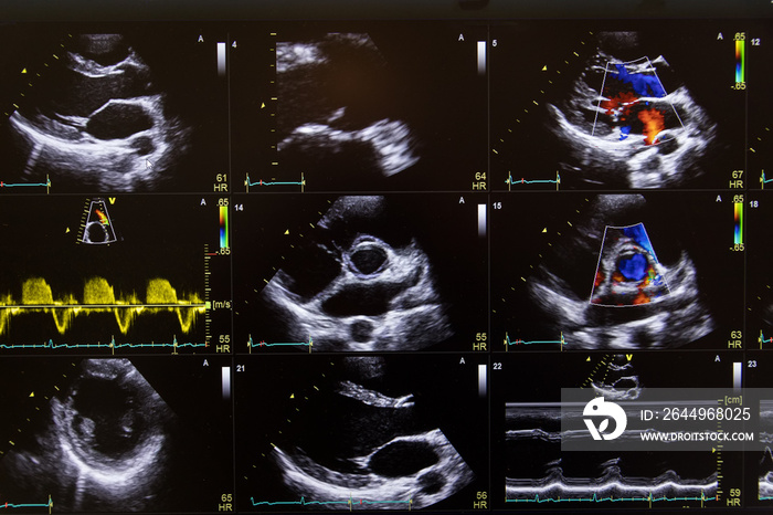 Heart ultrasound image on a computer screen.