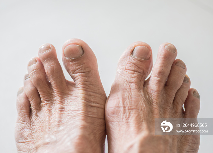 Elderly and senior toenails become brittle, deteriorate and have nail fungus.