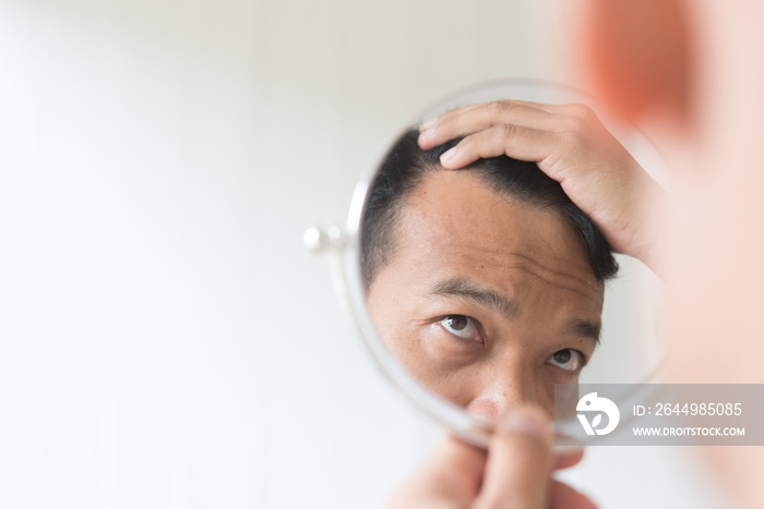 Men are worried about hair loss.