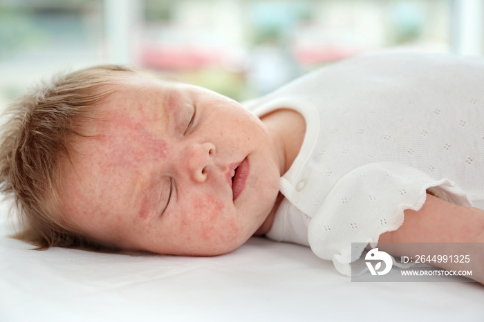 Adorable baby with skin allergy indoors