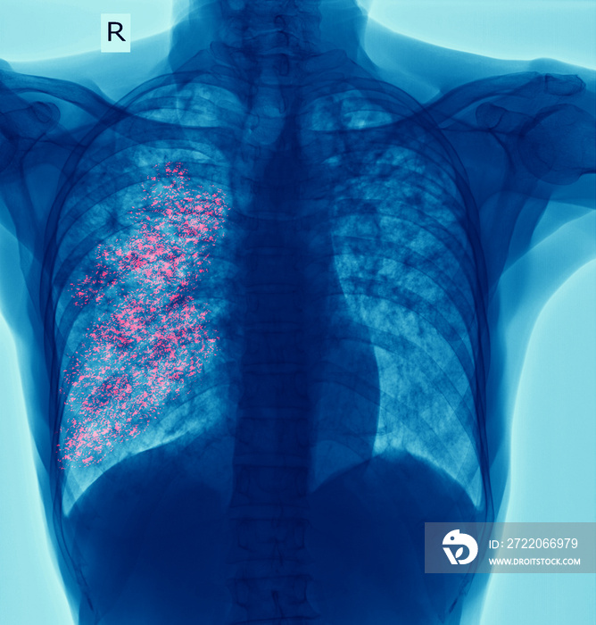 x-ray of chest show cavity at right lung and interstitial infiltrate both lung due to TB infection