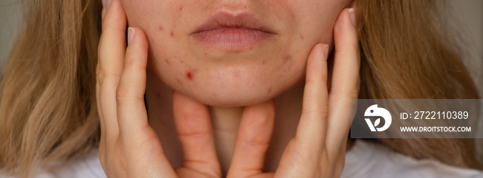 Unrecognizable woman showing her acne on face. Close-up acne on woman’s face with rash skin ,scar and spot that allergic to cosmetics. Banner Problem skincare and health concept. Wrinkles, melasma