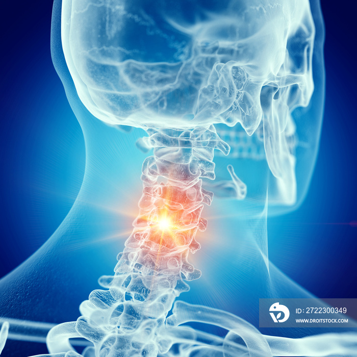 颈椎疼痛的三维医学精确图示