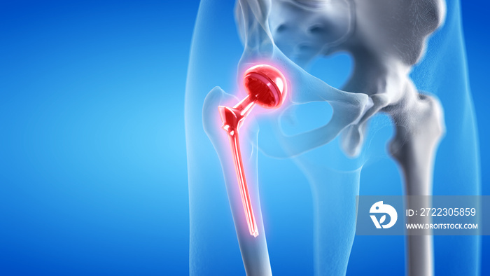 3d rendered medically accurate illustration of a painful hip replacement