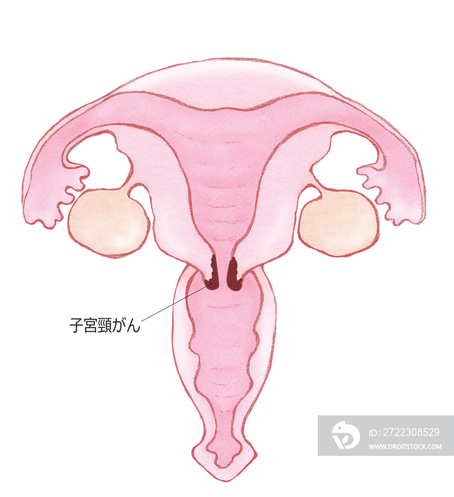 子宮頸がん　子宮のガン（名称あり）