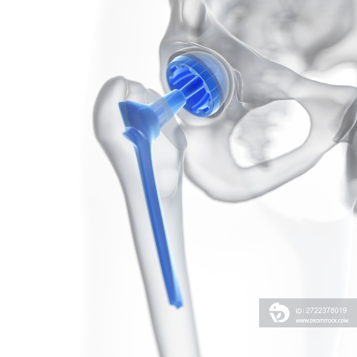 髋关节置换术的三维医学精确图示