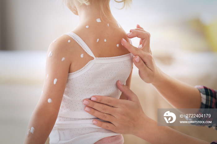 Female hands applying cream on little girl with chicken pox at home