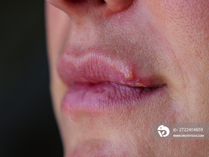 CLOSE UP: Detail view of top lip affected with blister caused by herpes simplex