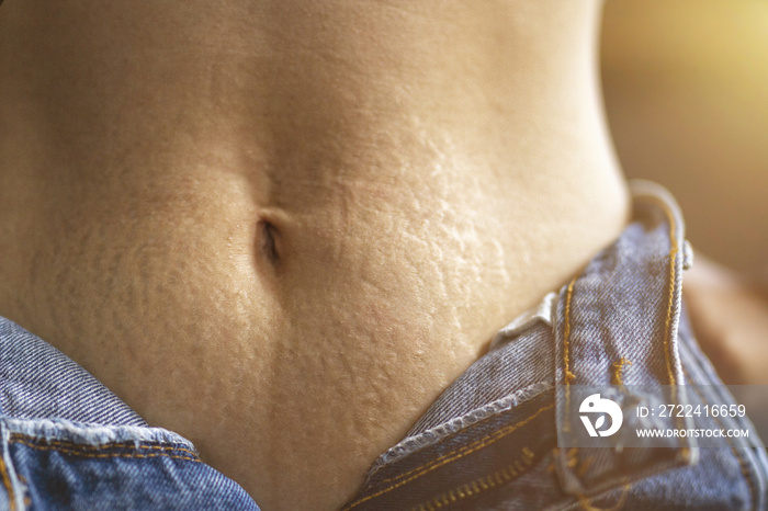 Stretch marks skin, Woman showing stretch marks on the lower abdomen.