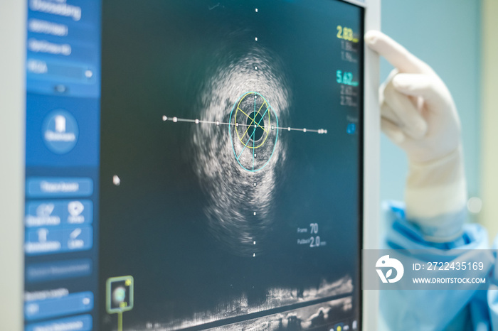 Intravascular ultrasound imaging (IVUS) at cardiac catheterization laboratory room.